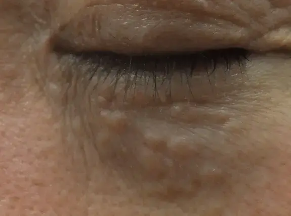 汗管腫