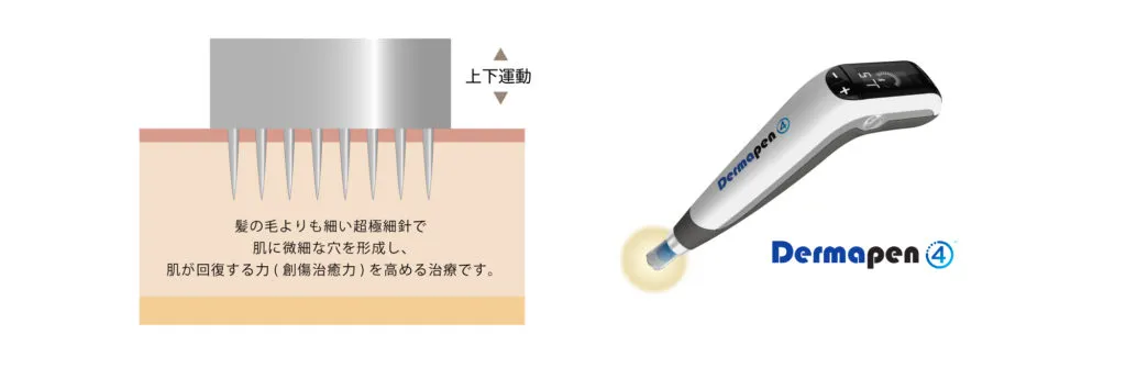 ダーマペン4 皮膚断面・針の深度イメージ