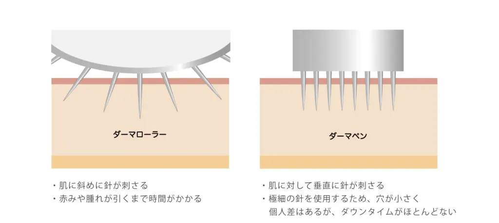 ダーマペンとダーマローラーの違い（垂直vs斜め）