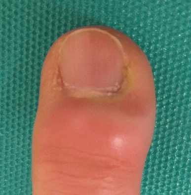 足 の 親指 の 痛み
