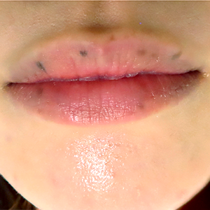 レーザーによる口唇の黒ずみ治療