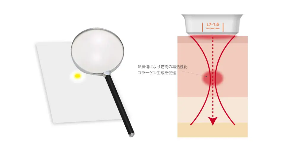 HIFU 高密度焦点式超音波 原理イメージ